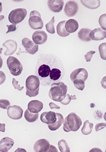 Hypogranular_neutrophil_with_a_pseudo-Pelger-Huet_nucleus_in_MDS
